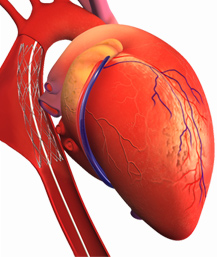 Coronary Angiography