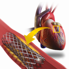 Coronary Stenting